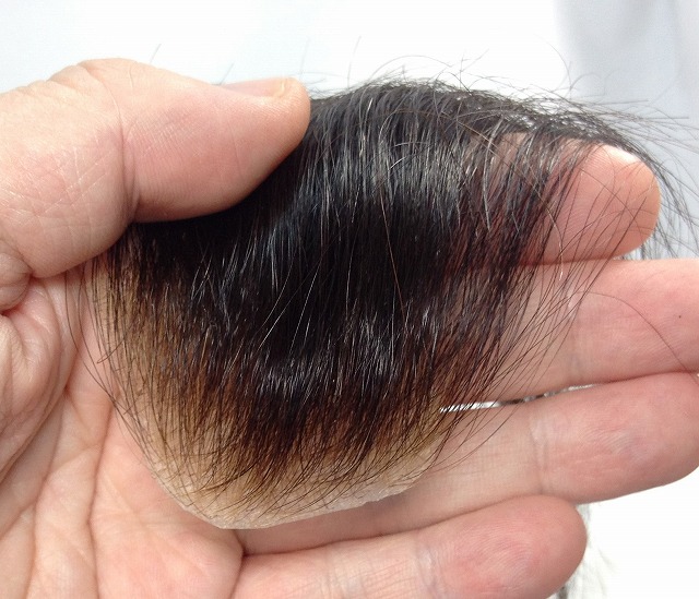 植毛vs増毛！前髪スカスカ。M字ハゲ改善・復活にはどっちがいい？徹底比較